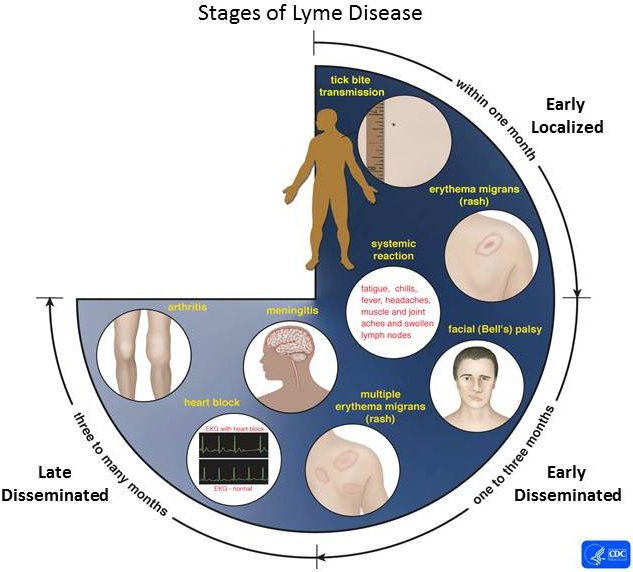 Lyme_Stages.jpg